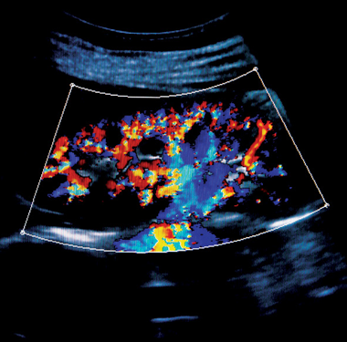 ultrasound in medical devices