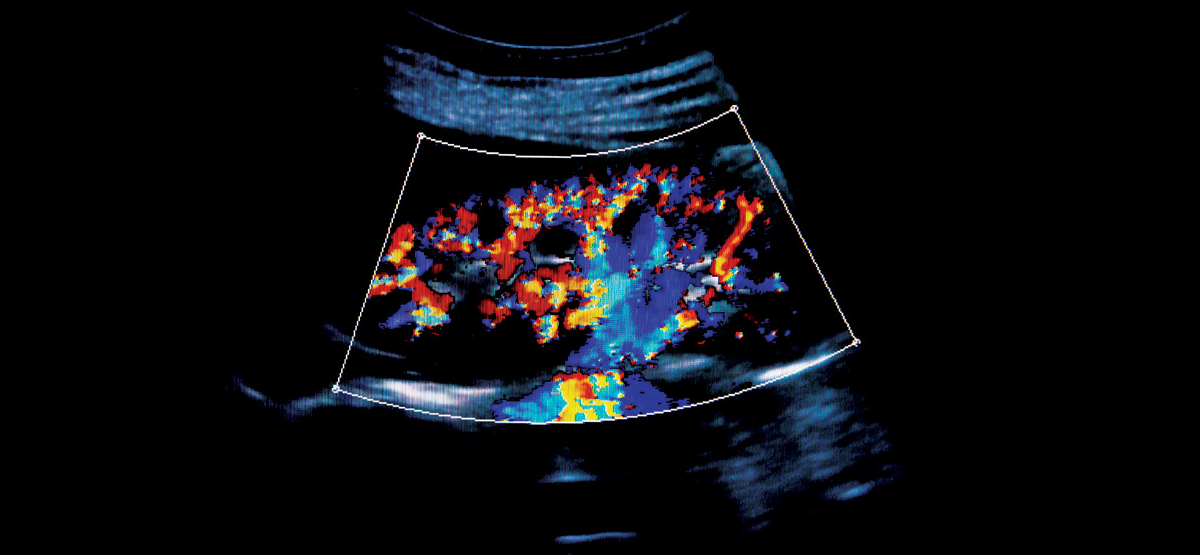 ultrasound in medical devices