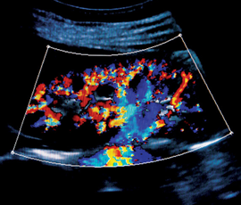 ultrasound in medical devices
